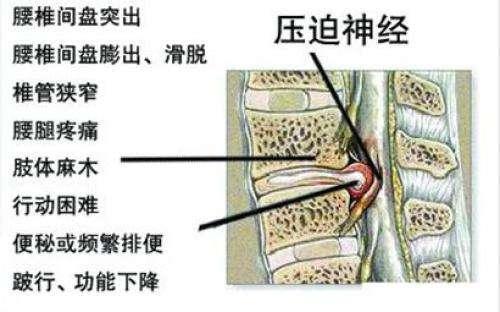 卧如弓是腰椎间盘突出首选 3种护理原则 缓解腰腿痛!