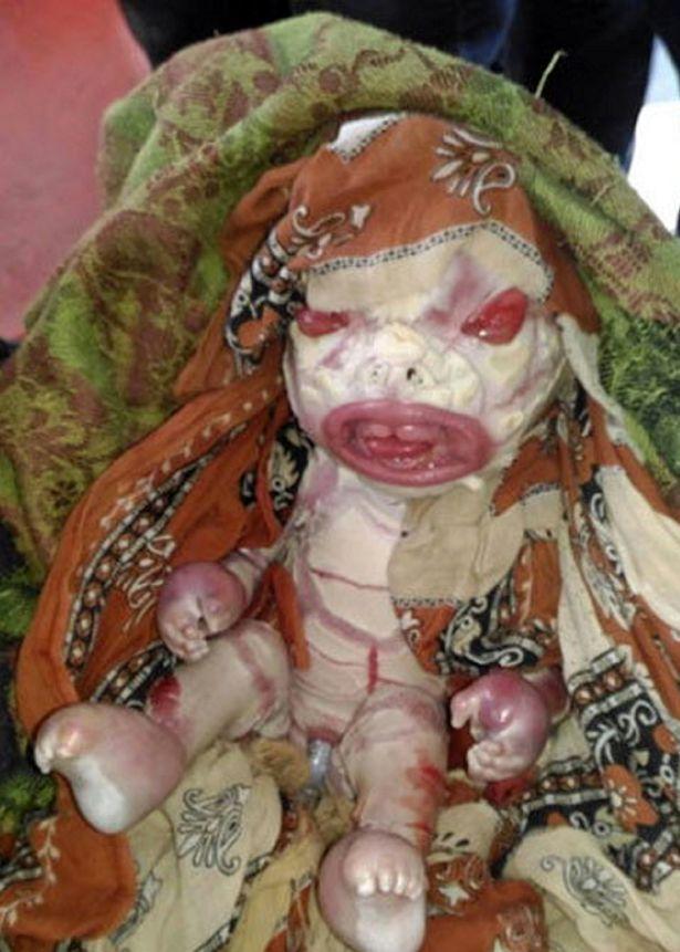 印度婴儿全身布满鱼鳞酷似外星人 妈妈不愿哺乳:只