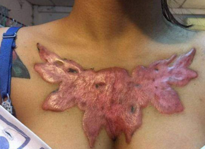 用了不正规的药水洗纹身,结果长出了肉瘤泰国女子苦不