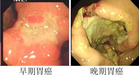 出现这3种情况,立即去做胃镜,每拖一天都有胃癌风险